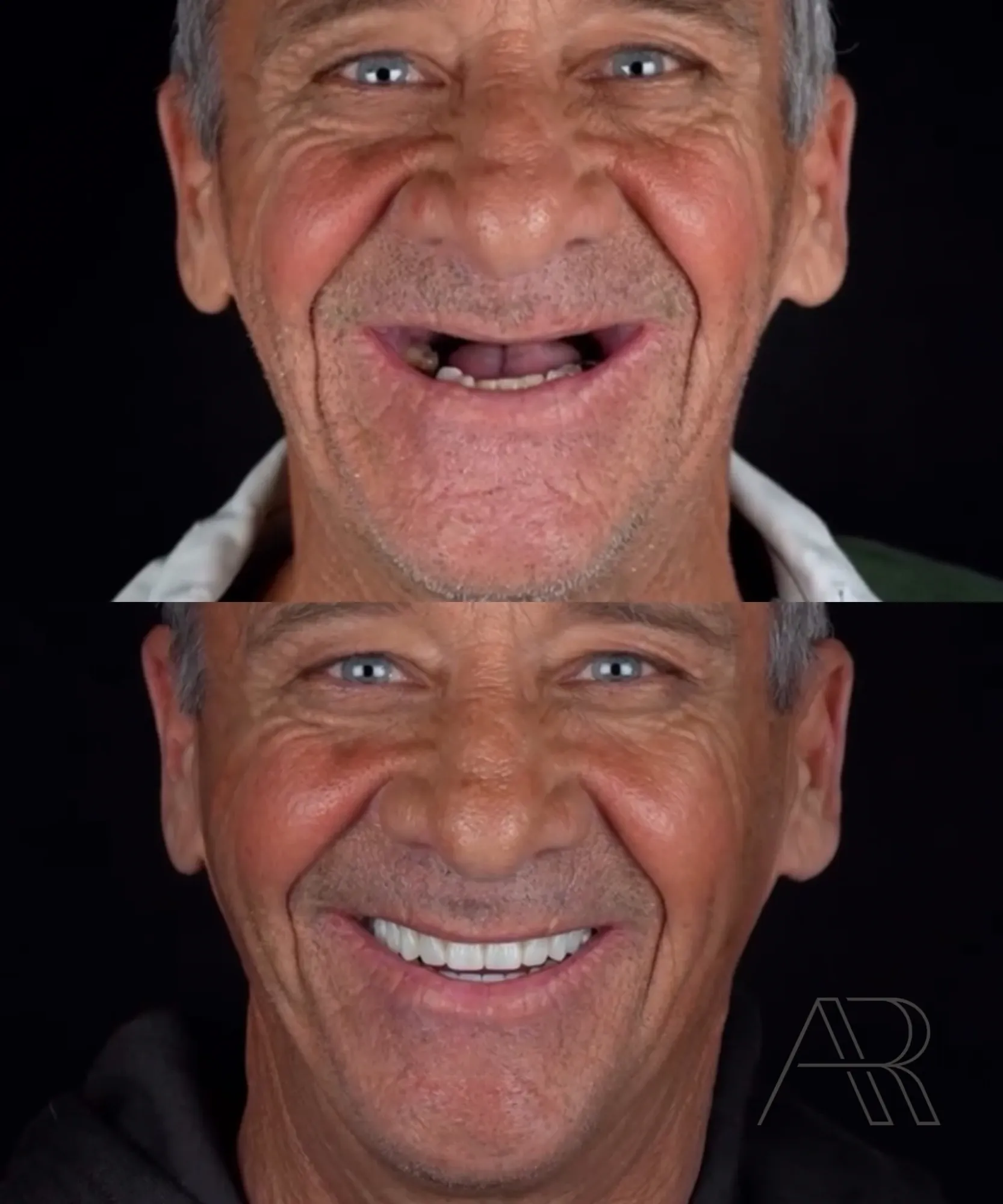 Antes e depois de protocolo sobre implantes: detalhe do sorriso do mesmo paciente