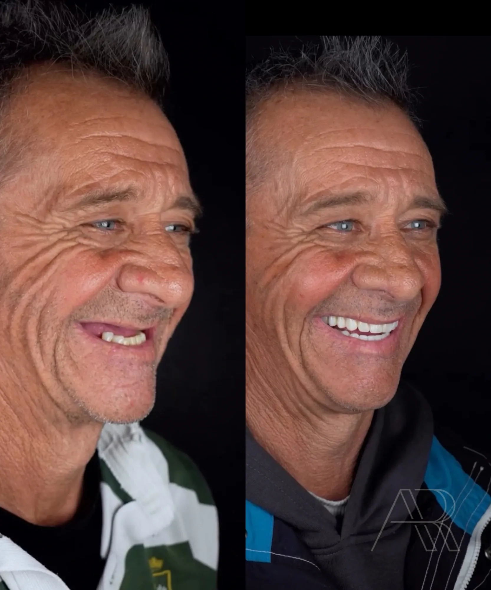 Antes e depois de protocolo sobre implantes: o mesmo paciente de perfil