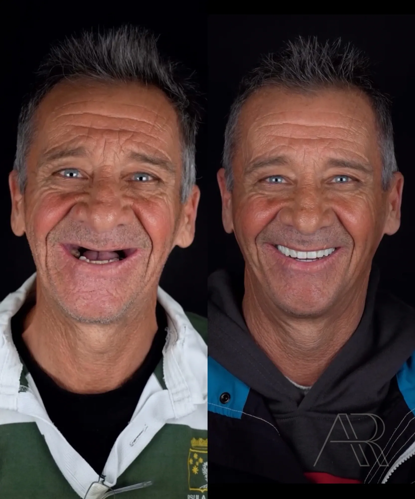 Antes e depois de protocolo sobre implantes: paciente de frente, sorrindo