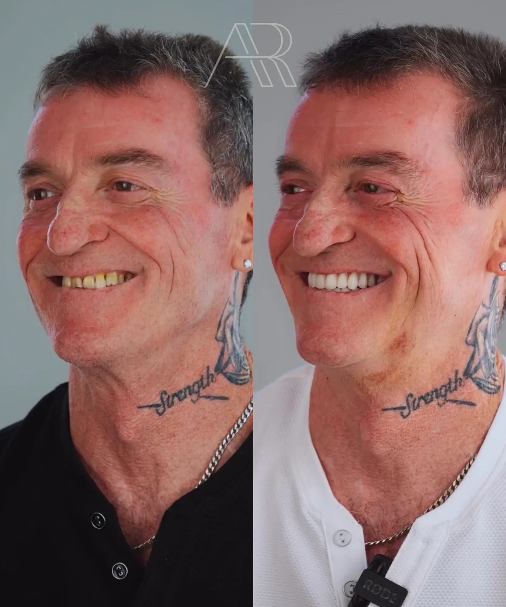 Antes e depois de protocolo sobre implantes: segundo paciente de perfil